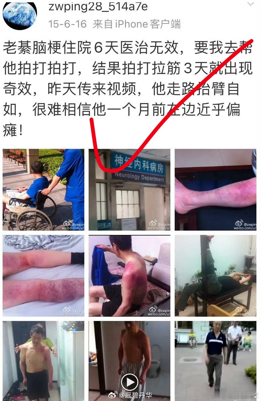 #中医式生活# 【拍打肘窝】自救胸痛心梗或互救晕厥猝死能够立见捷效，是基于《黄帝