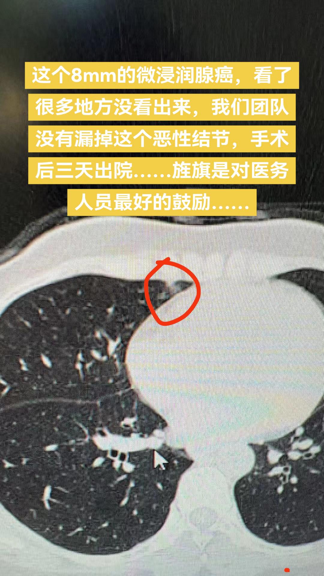 这个8mm的微浸润腺癌，看了很多地方没看出来，我们团队没有漏掉这个恶性...