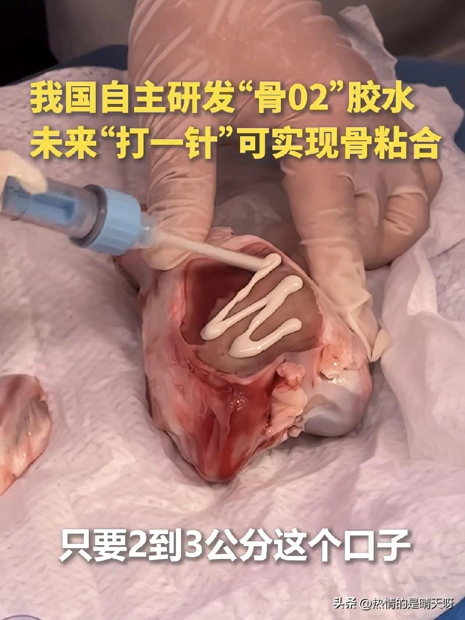 医学创新！武侠小说中的黑玉断续膏走进现实！

我国自主研发“骨02”胶水成为世界