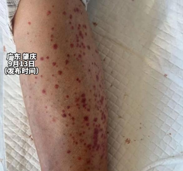 悲剧还是发生了！9月2日，广东肇庆，74岁老太在院子里喂鸡时，不小心被鸡啄了一口