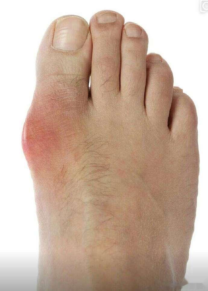 #国医的精诚力量# 痛风方痛风方：黄芪20-30g、麦芽15-20g、山药15-