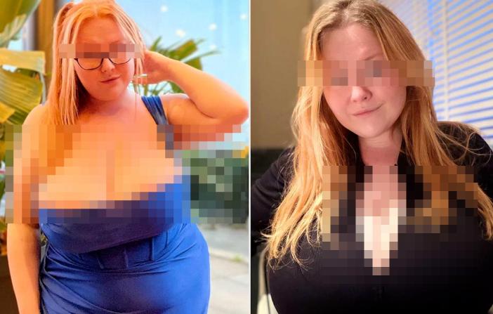 英国女子服减肥药后确诊罕见巨乳症，胸部疯长至35斤，占总体重的20%


对于许