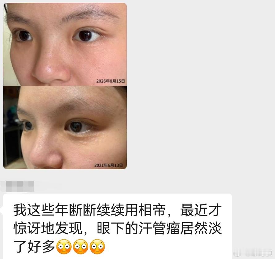 断断续续用相帝，惊奇地发现眼周的汗管瘤好了很多。 
