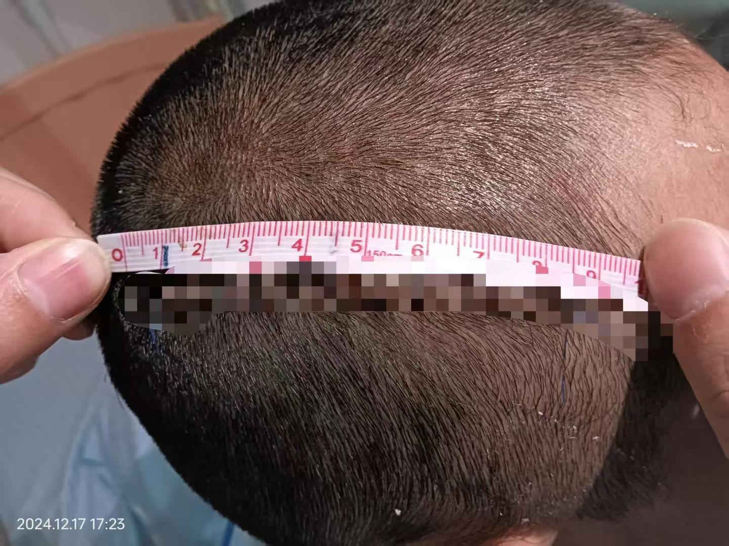 #爷爷误会孙女被打将其6岁同学重伤#【7岁女生在校嬉戏受伤，爷爷以为其被殴打，将