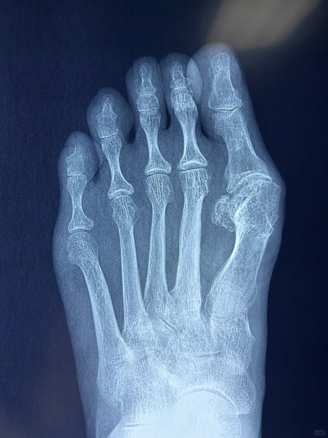 12年前的微创手术