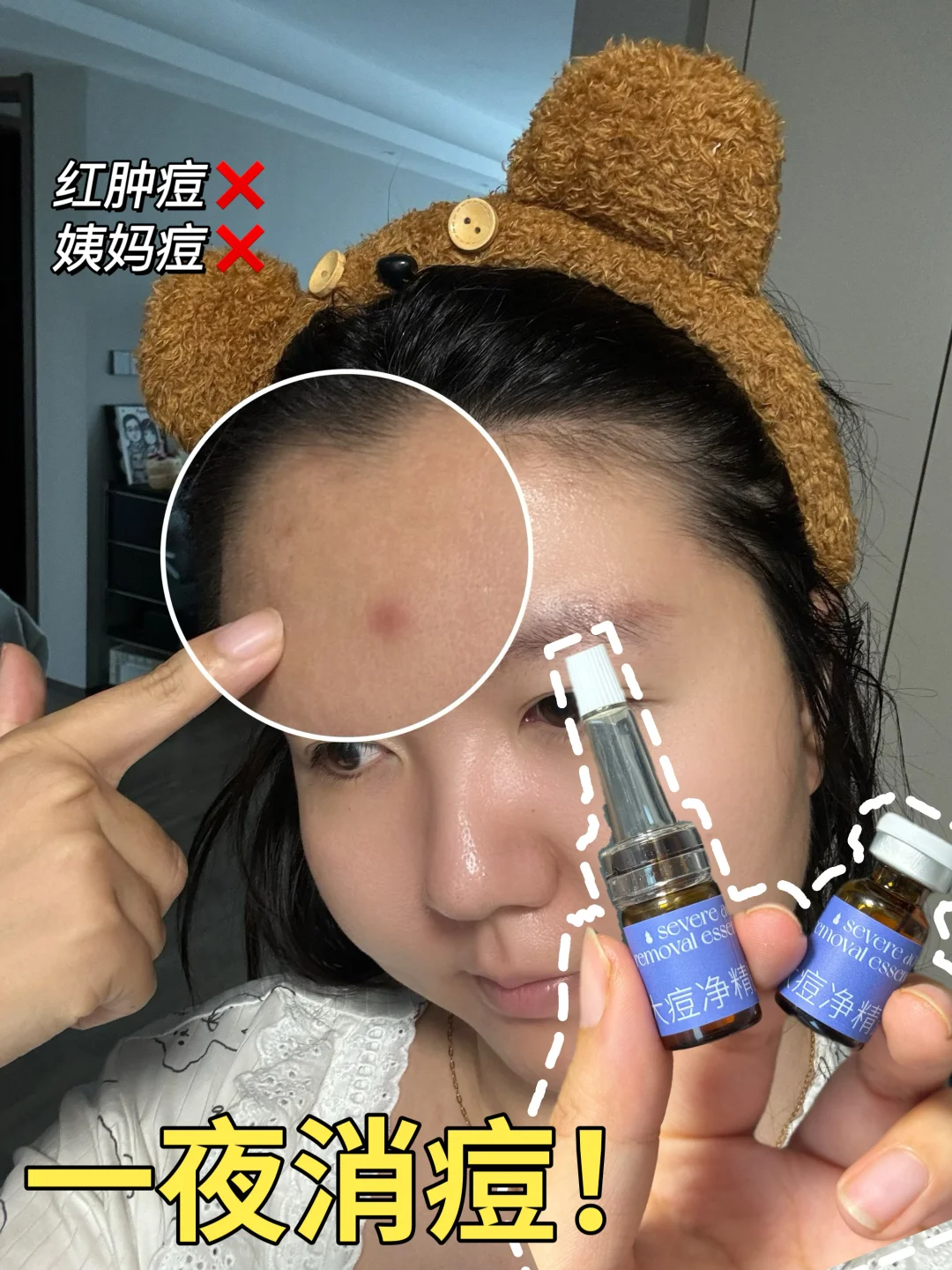痘痘就这么水灵灵的消失了？！瘪痘一绝！