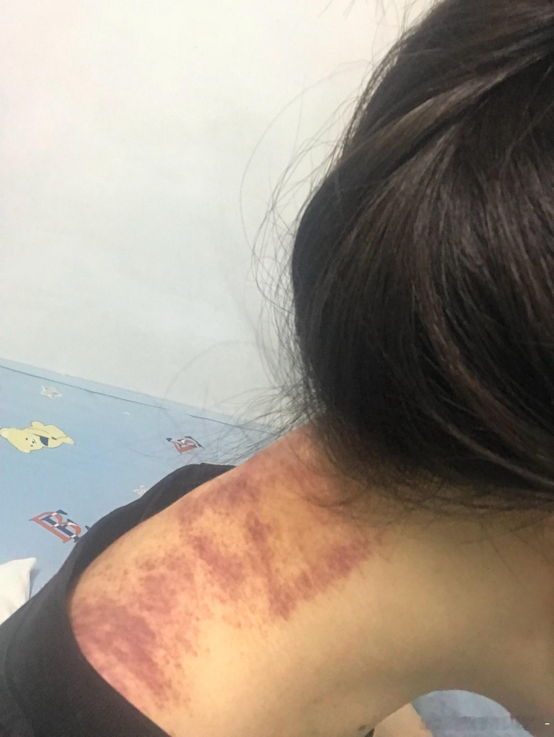 昨晚去理疗按摩按摩师用精油给我按摩啊啊啊一股味道很不喜欢又不能洗澡，一晚上的被熏