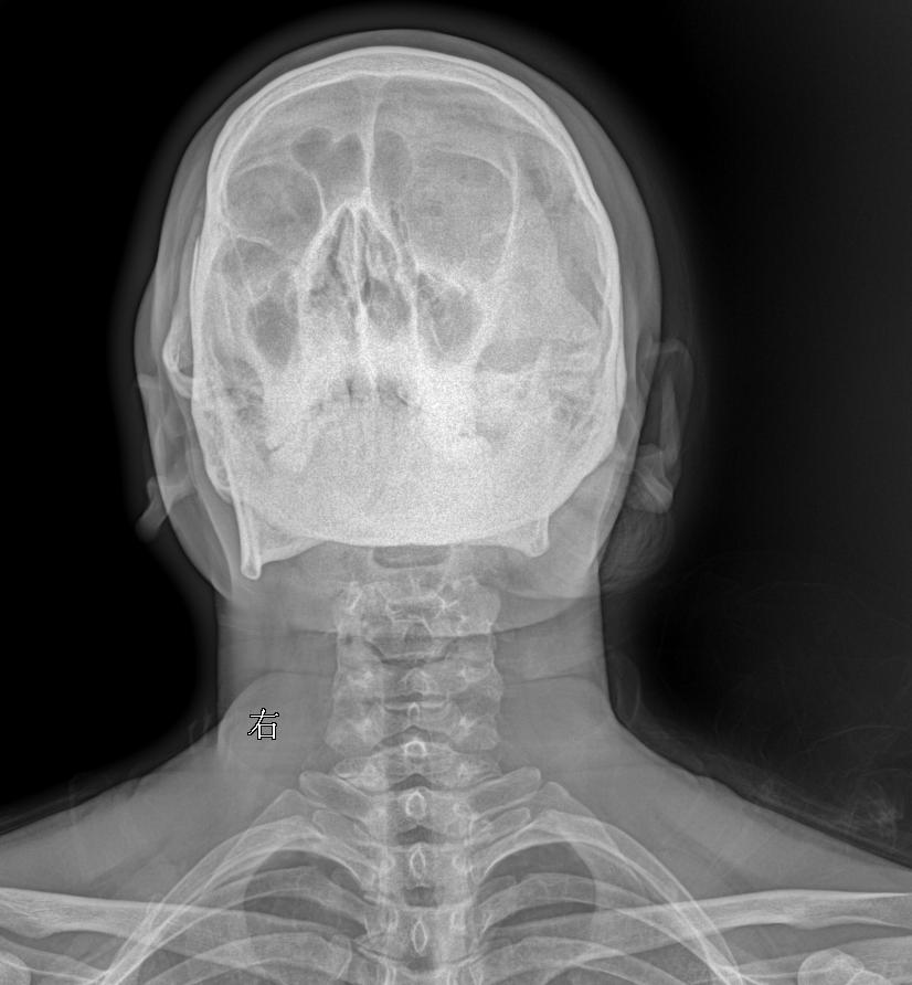 来张颈椎四位片瞅瞅大家怎么拍的