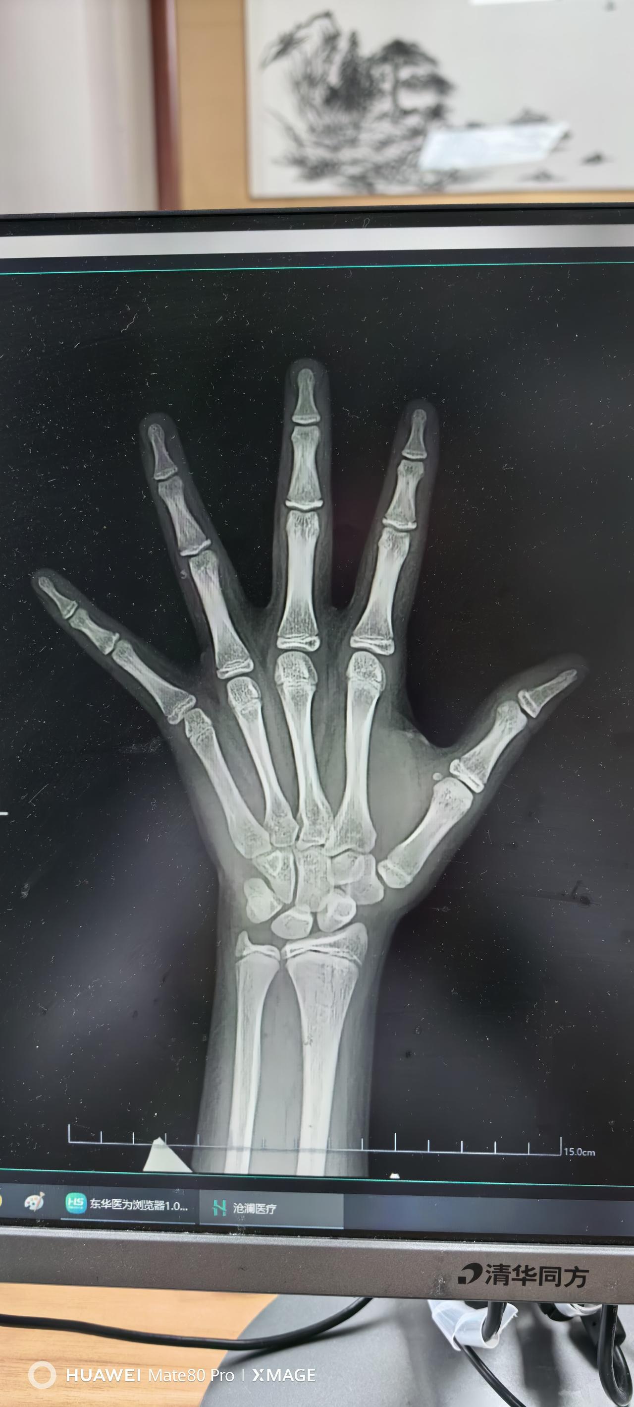 儿科医生日常案例分享：女孩，10岁9个月，月经来潮6个月，生长速度明显减慢，但和