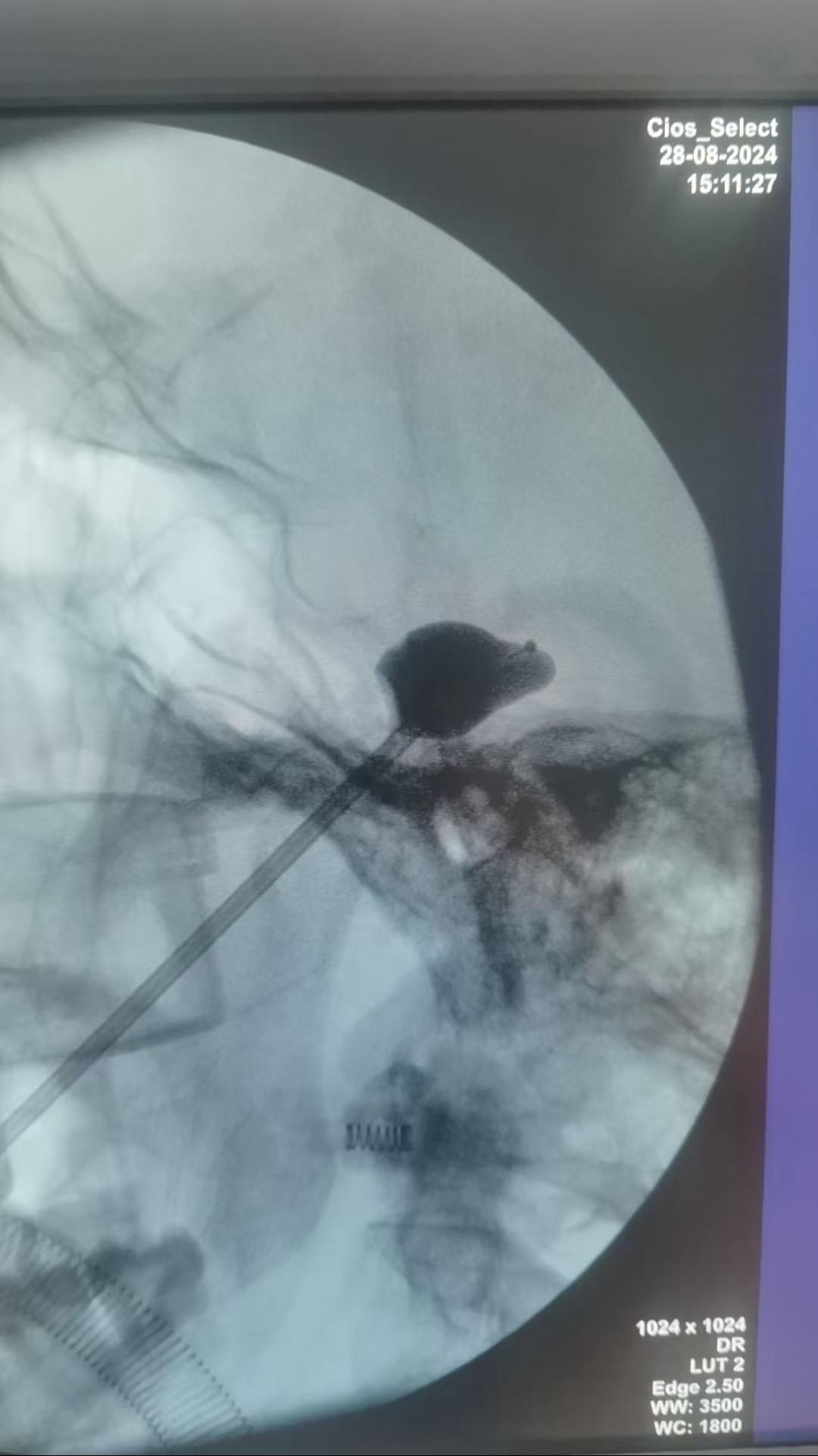 天下武功，唯快不破。针对复发或者不适合手术的天下第一痛---三叉神经痛...