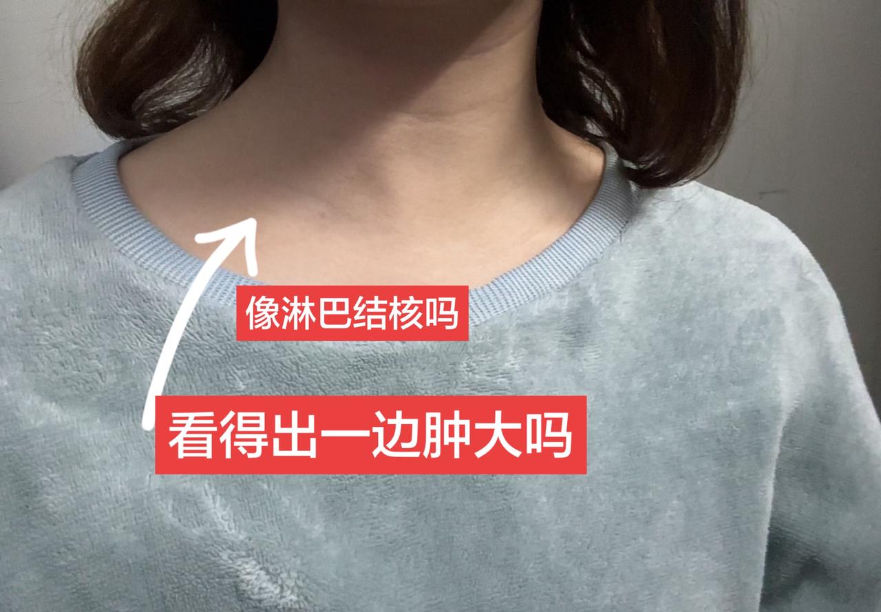 广大的朋友，两边脖子相差远吗？今天又做检查了，医生说疙瘩太小了，不建议活检，不一