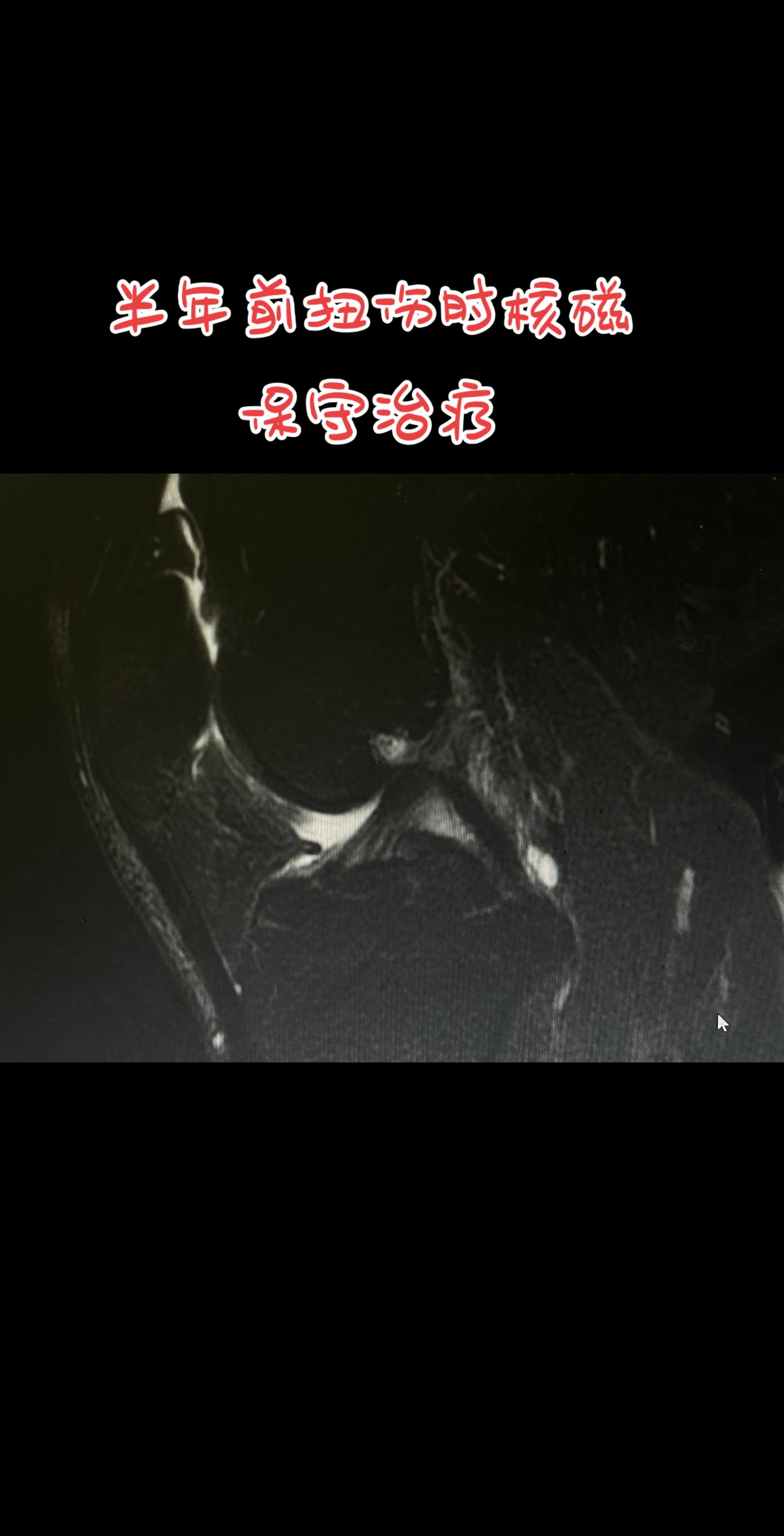 前叉损伤后继续运动的后果。前叉损伤不重保守治疗不代表就一定会好