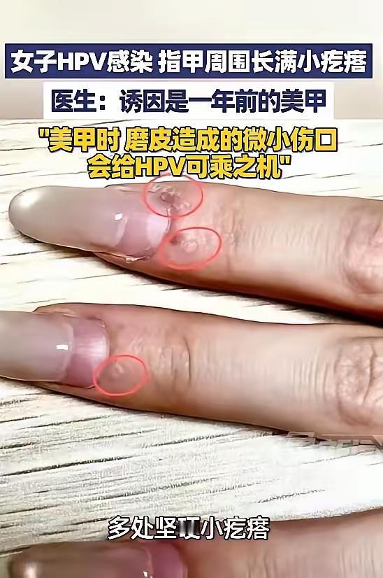 太吓人了！”
5月9日报道，浙江杭州，一女子发现她的指甲周边，长了许多粗糙坚硬的