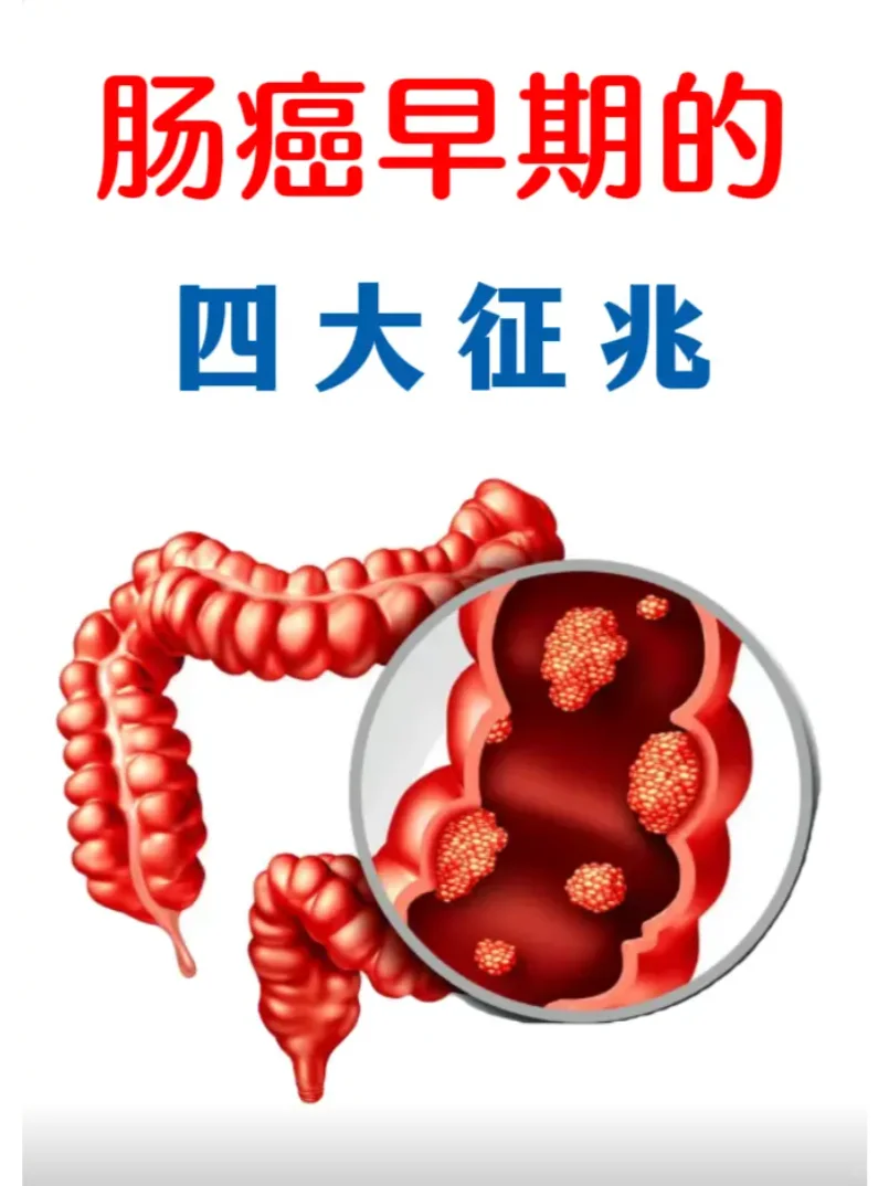 肠癌早期四大征兆，出现了千万别大意！