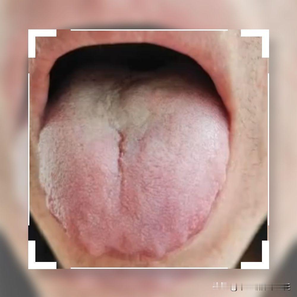 越是天冷，这种舌头就越多，毛病就越多，只靠补肾是解决不了问题的！

我们来看这位