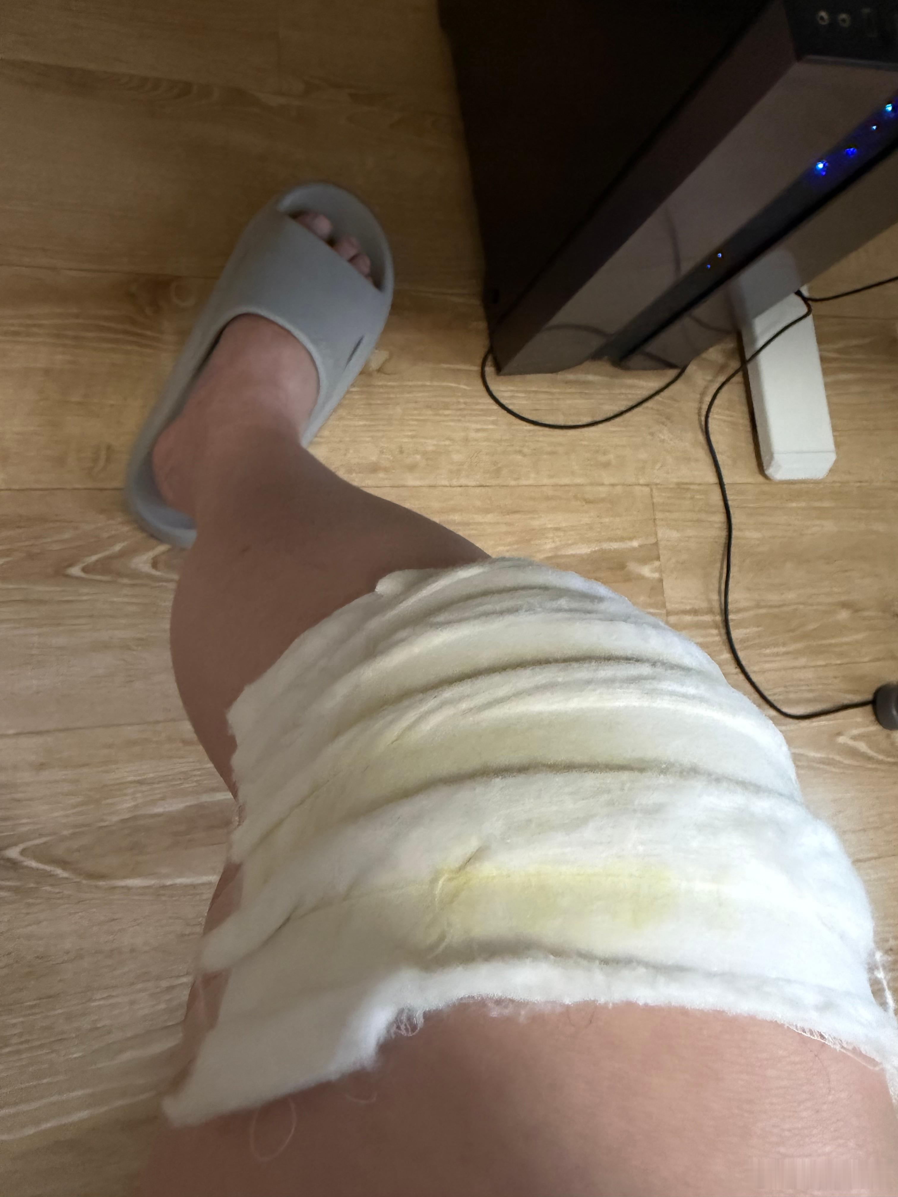刚才老婆陪着去医院，输液的时候被老婆骂了一顿。就是折腾，弄得一身病。本来膝盖积液