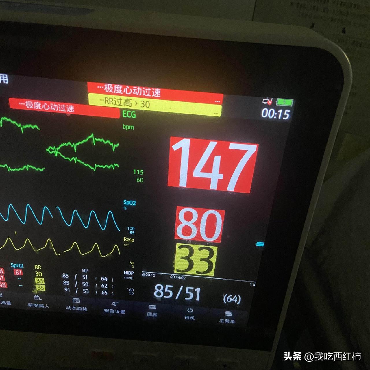 老公又进了抢救室
距离出事差不多一年了，这半年自己一个人在医院擦屎端尿照顾他，没
