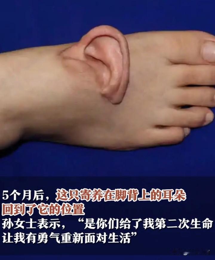 谁能想到，掉了的耳朵还能“暂住”脚背，五个月后再搬回原位？山东一位女士的经历，简