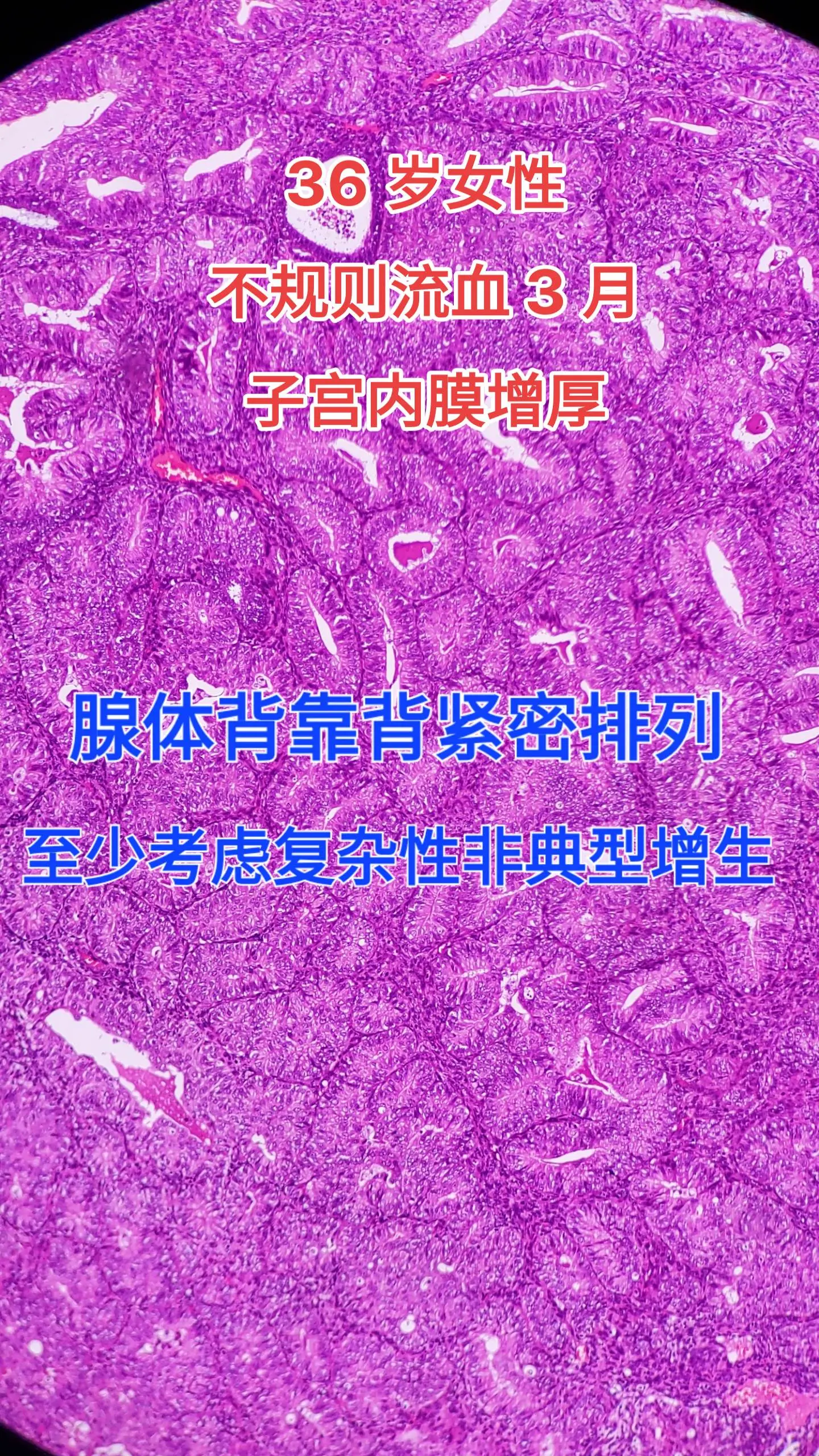 不规则阴道出血 子宫内膜增厚 子宫内膜非典型增生  子宫内膜样腺癌