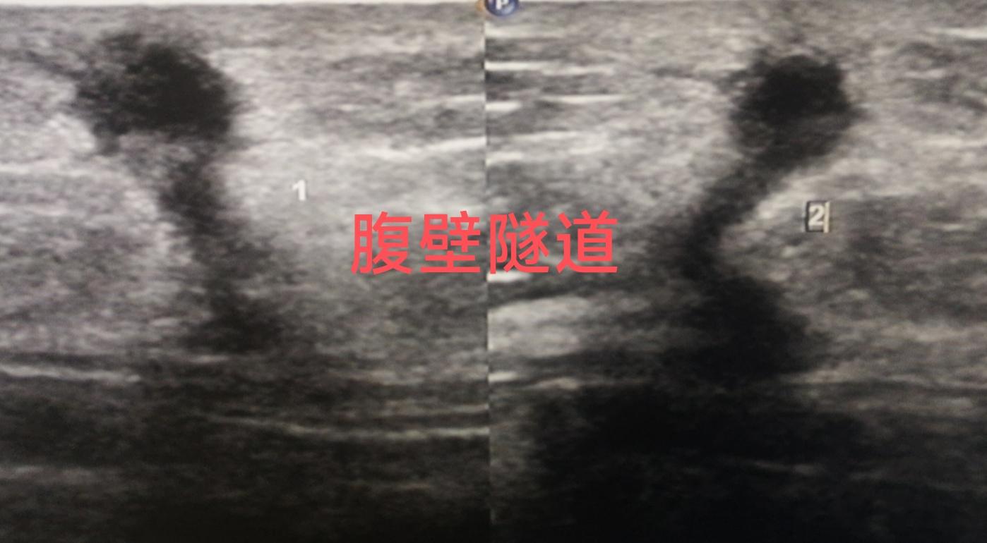 腹壁隧道样低回声。腹壁隧道 老年女性，腹部包块来检查 皮肤表面未见明显...