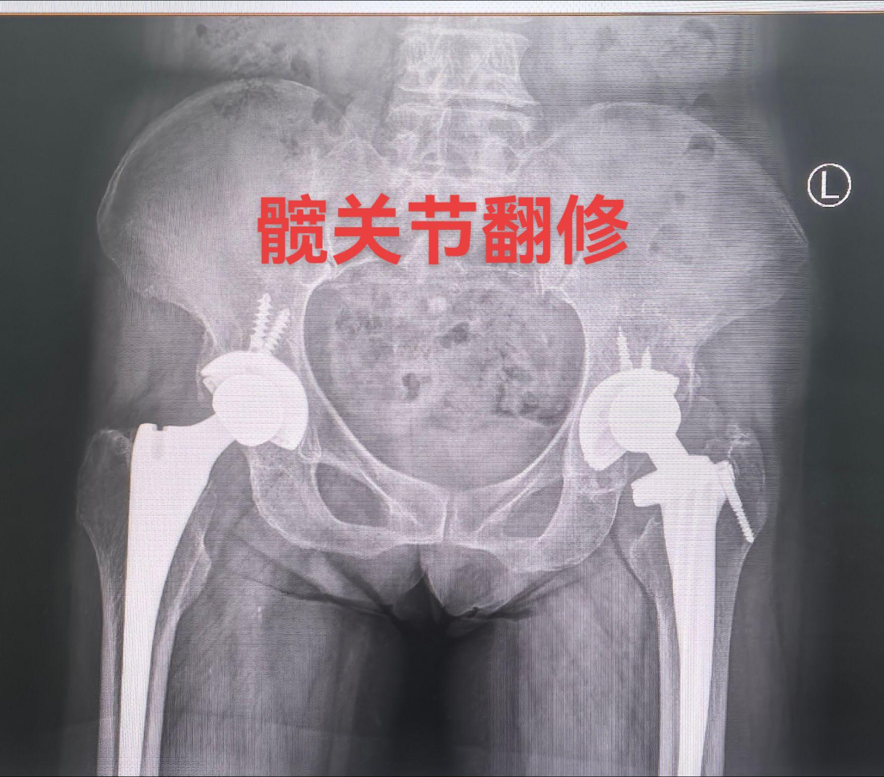 髋关节翻修。髋关节置换术后22年，假体磨损，骨溶解，无菌性松动，翻修术...