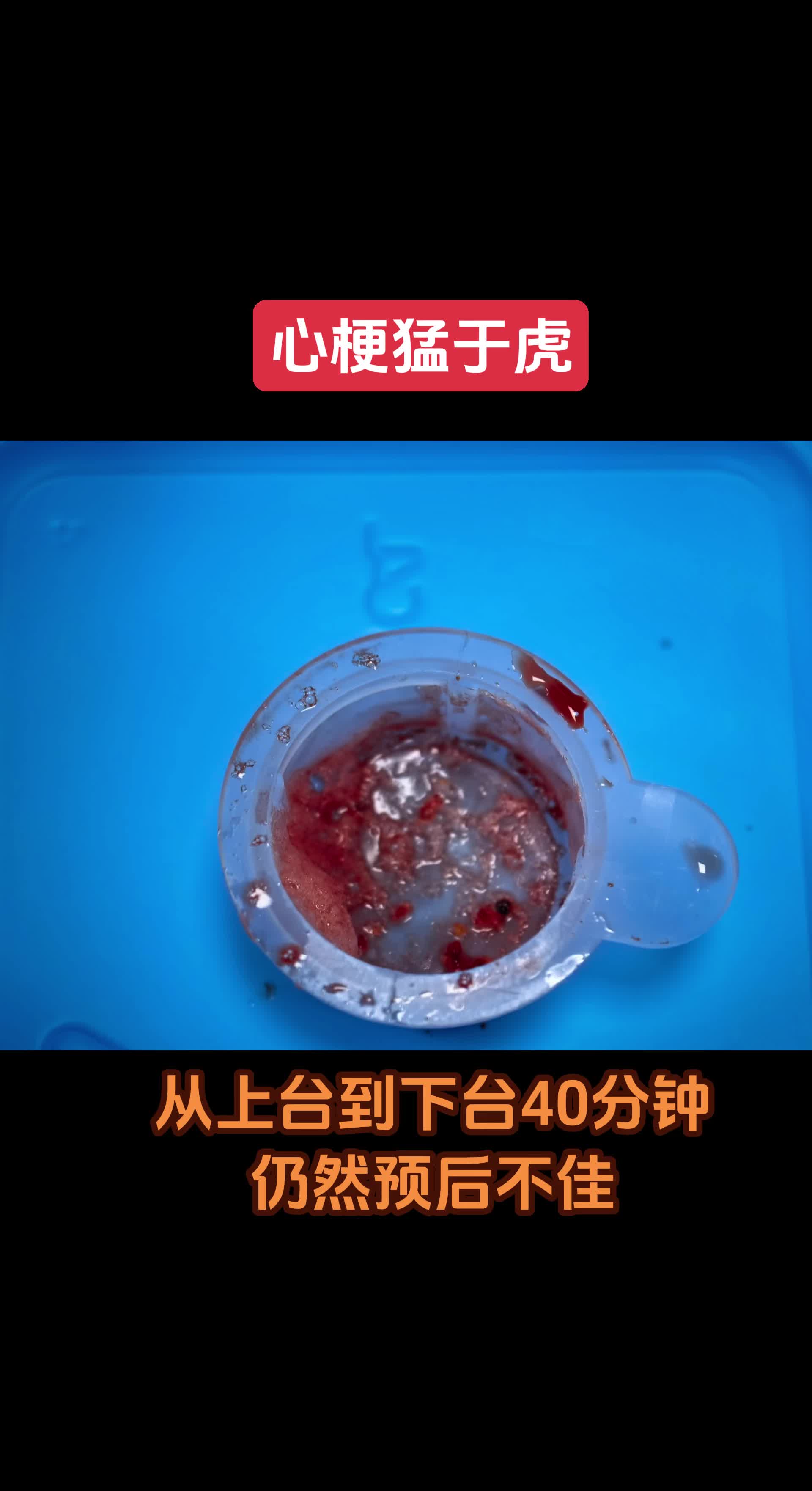 时间就是心肌，心肌就是生命 心梗猛于虎，重度血栓负荷，抽出数枚血栓！