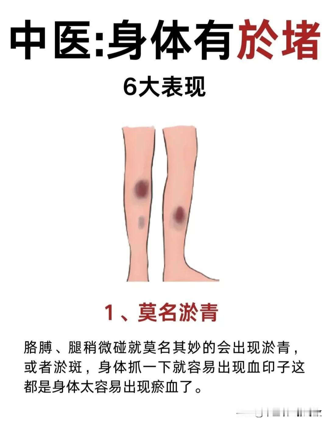 身体有淤血的6大表现，一起来看下你身体淤堵了没？
中医说，淤血，身体健康的头号杀