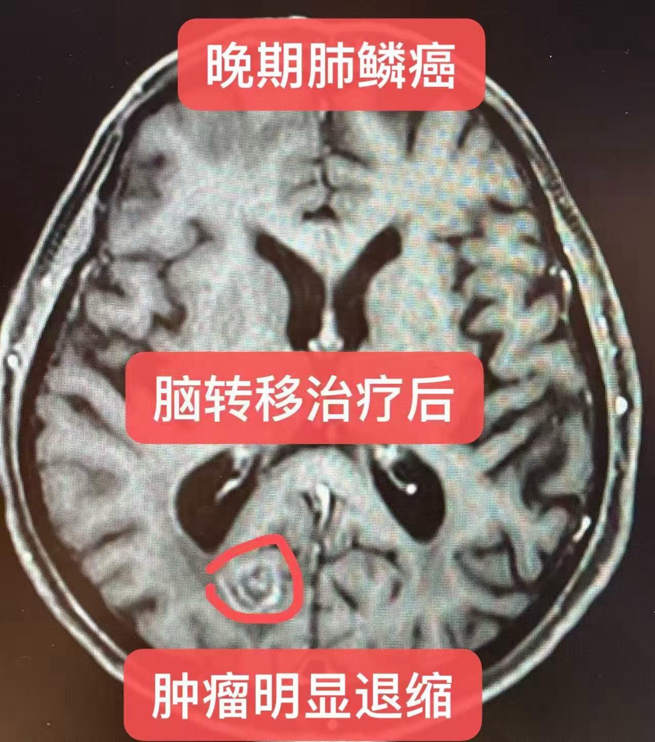晚期肺鳞癌，脑转移！肺鳞癌，多发脑转移的治疗！ 患者男，72岁，头晕一...