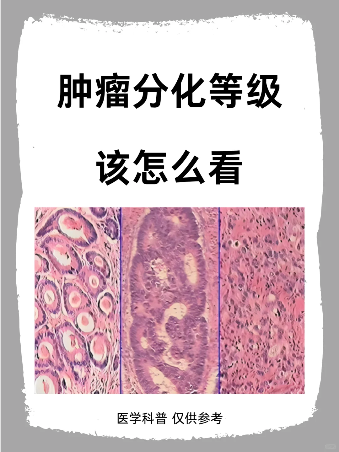 今天为大家科普一下恶性肿瘤分化等级