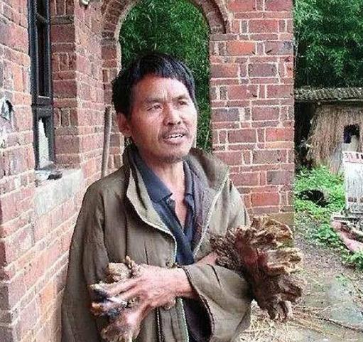 我快要疼死了！1992年，湖南，一个小伙子半夜被疼醒，打开灯一看，他发现自己竟然