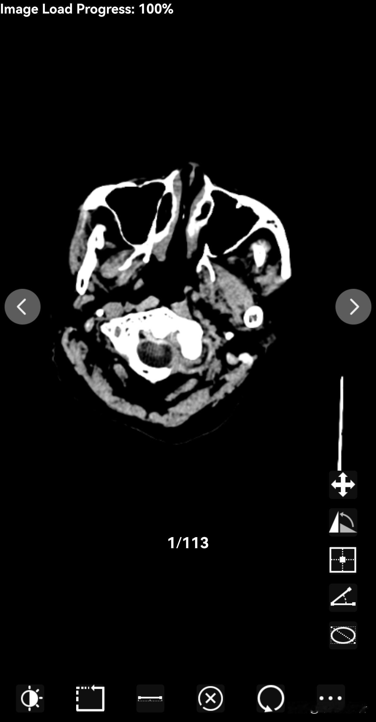 我妈妈12月19日因为血压高导致摔倒，接着不能说话，同时也不能自己单独走路。
然