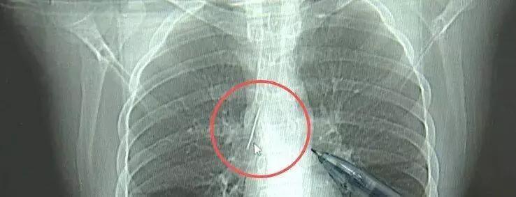 17岁小伙参军体检，竟在胸部发现一根5cm的缝衣针，位置极其凶险，这事儿简直太离