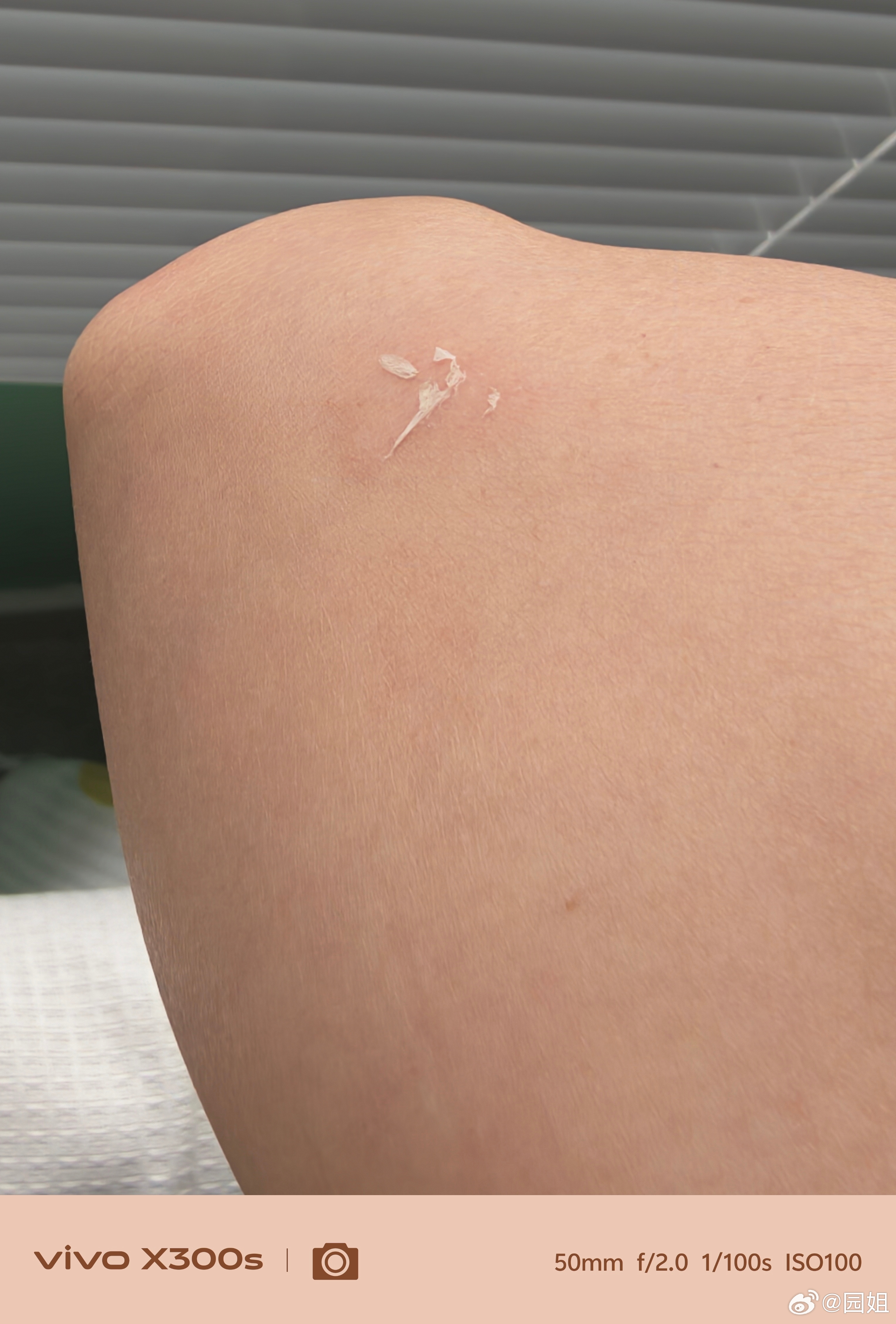 今天我水逆，左胳膊伤了，右胳膊伤