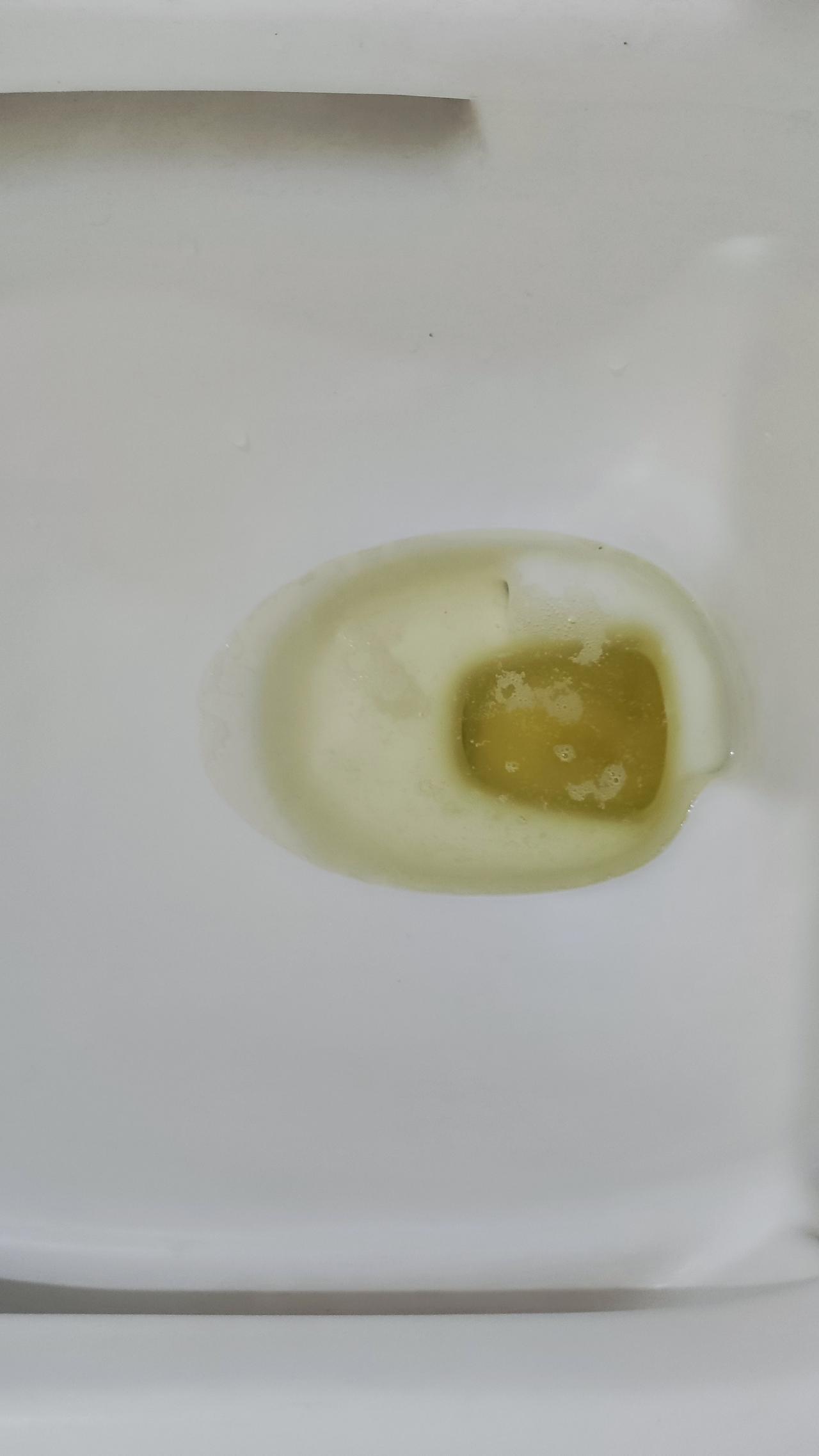 昨天突然发现小便有泡沫，而且一直不散，后来我刷了刷马桶，再小便就没有泡沫了。可是