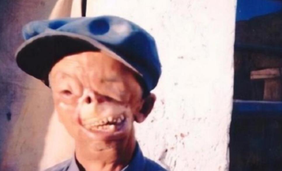 1950年，3岁的他被狼咬掉了半张脸后，被父亲无情的扔到山洞中，没哟想到他却顽强