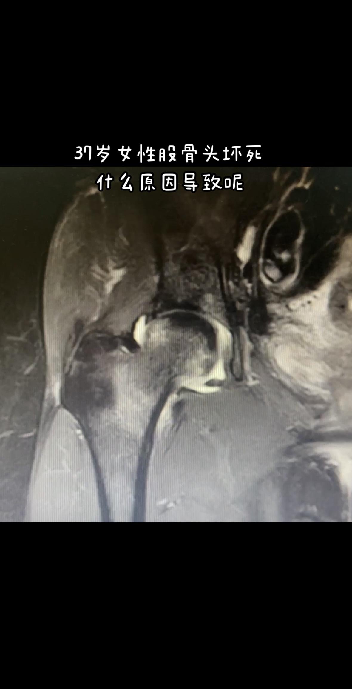 年纪轻轻股骨头坏死是什么原因。股骨头坏死的病因