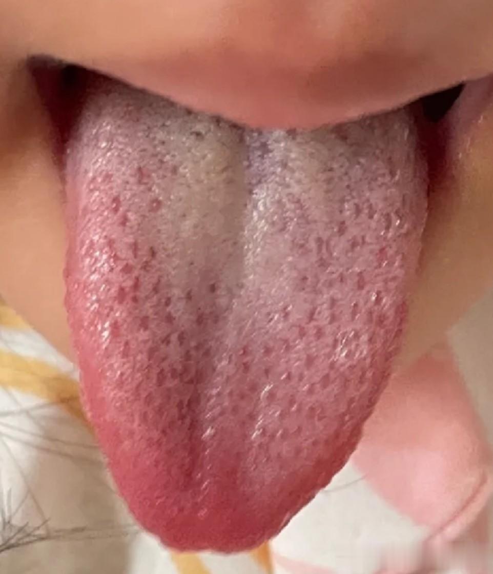 把女儿交给奶奶带后，积食还便秘，哎！是把胃撑坏了！
 
前段时间看诊了个5岁的小
