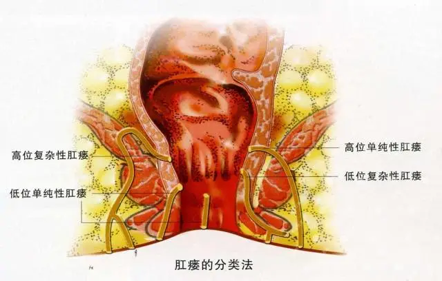 肛瘘分类