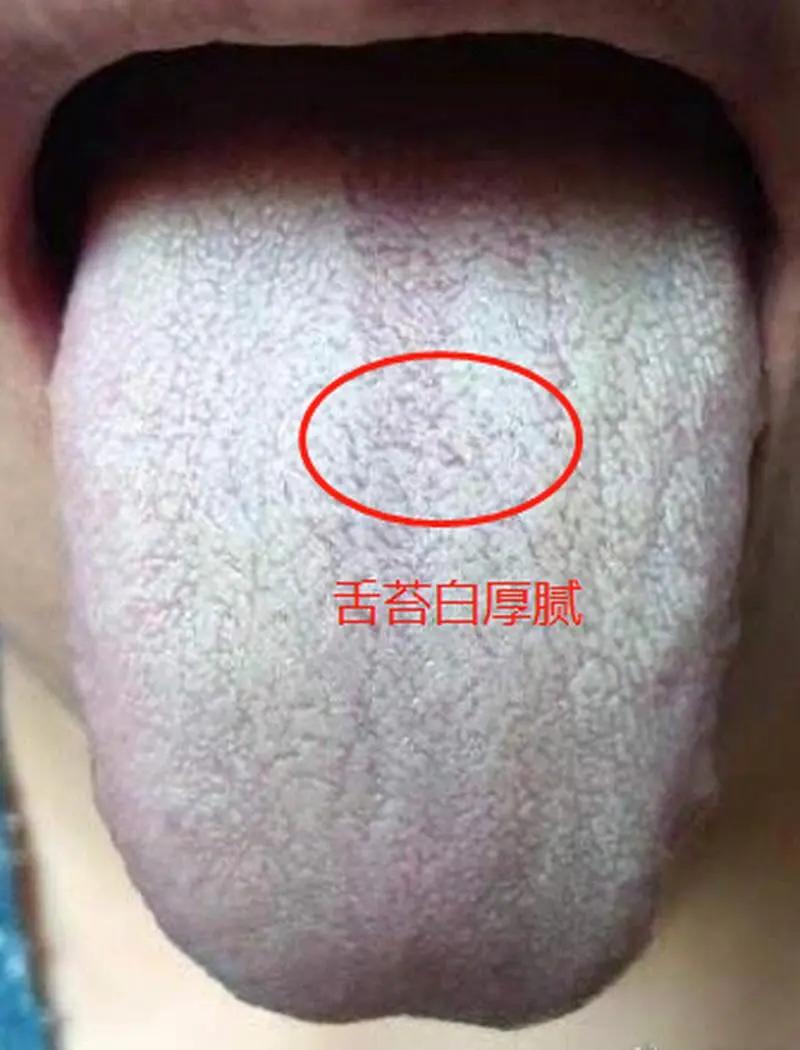 有没有湿气看舌苔就能知道湿气的状态。
舌苔白腻为寒湿，表现还有怕冷，吃凉拉肚子
