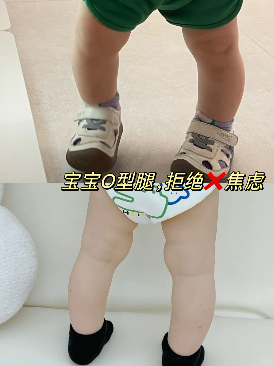 宝宝O型腿怎么办⁉️看看我亲身经历，拒绝焦虑