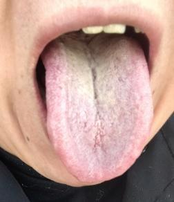 看见这种舌头，舌苔又厚又腻，再厉害的阳萎、早泄，也别急着用桂附地黄丸、金匮肾气丸