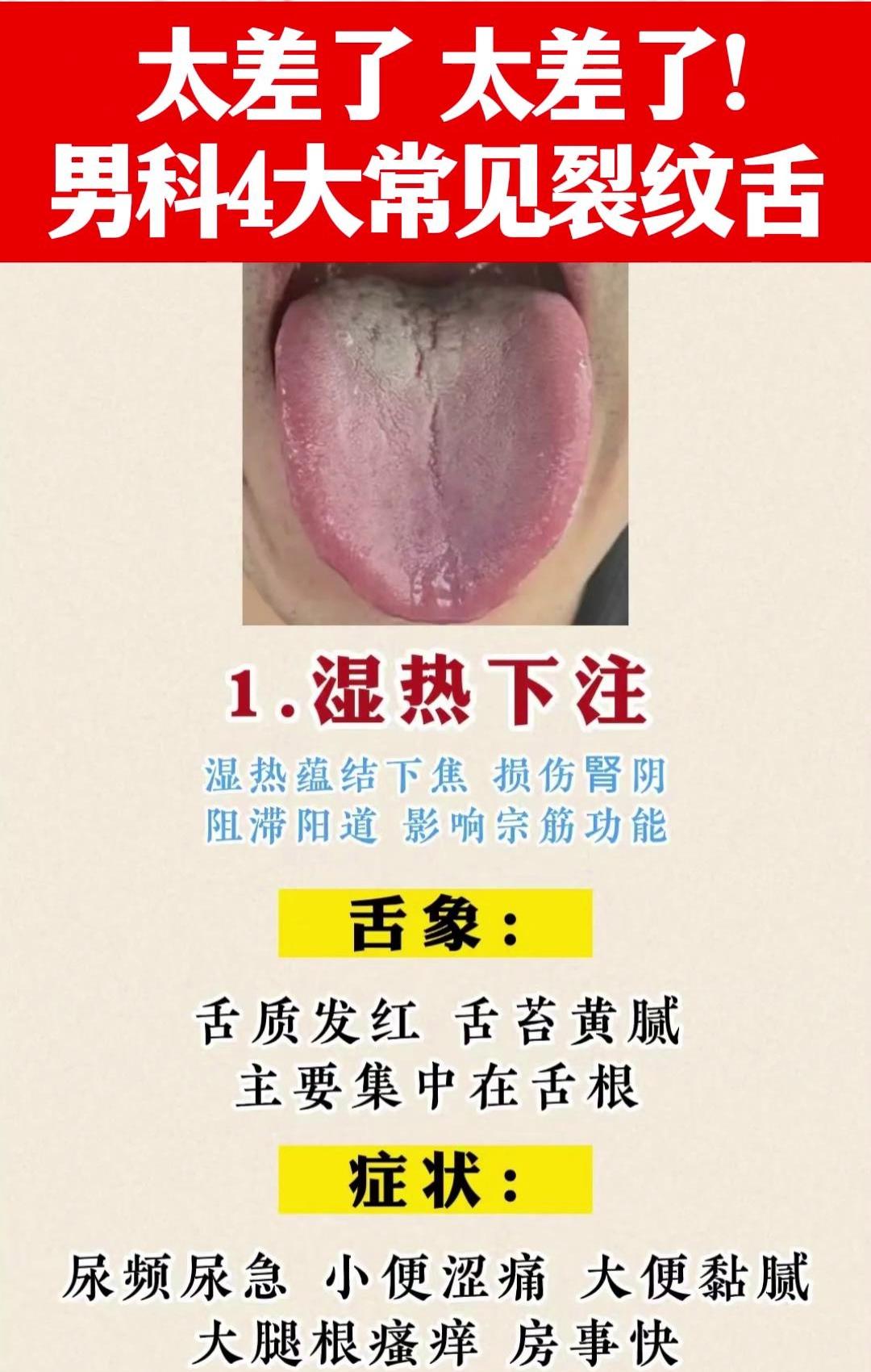 太差了！太差了！男科4大常见裂纹舌，你有这些问题吗？

1、湿热下注
症状：尿频