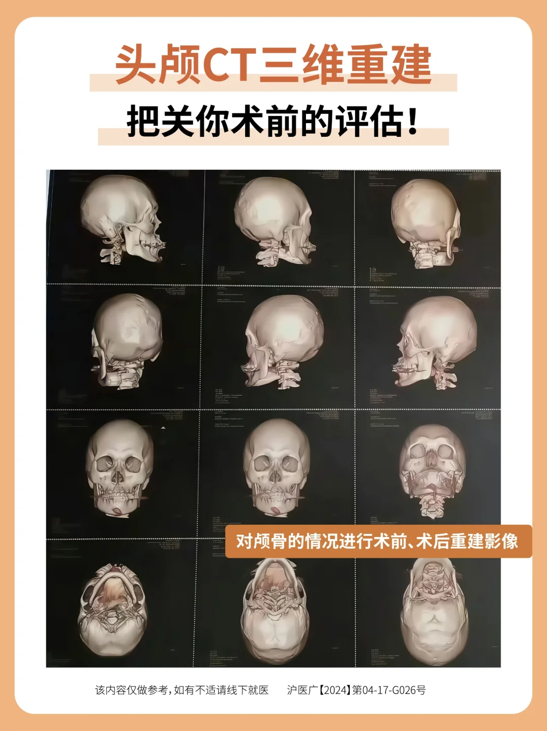 头颅CT三维重建，把关你术前的评估!