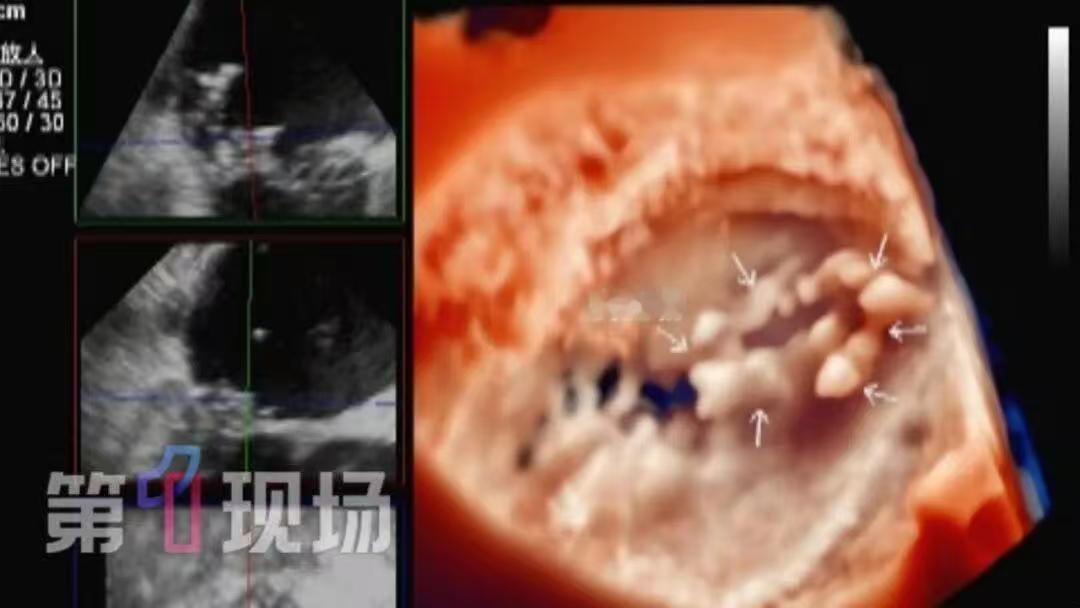 一颗长得像“马蜂窝”的赘生物，竟然在深圳一位51岁男子的心脏二尖瓣上安了家，体积