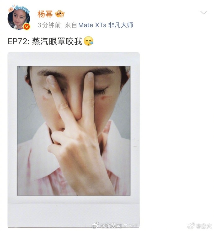 【#使用蒸汽眼罩时间过长易烫伤#】#建议使用蒸汽眼罩最佳时间15分钟#  27日