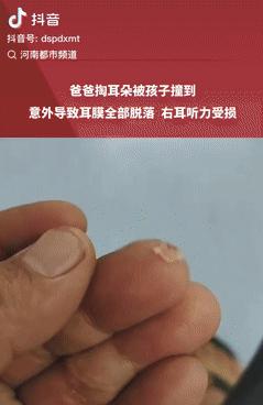 差点就悲剧了！8日报道，湖北襄阳一男子在家掏耳朵时，意外被2岁儿子撞了一下，结果