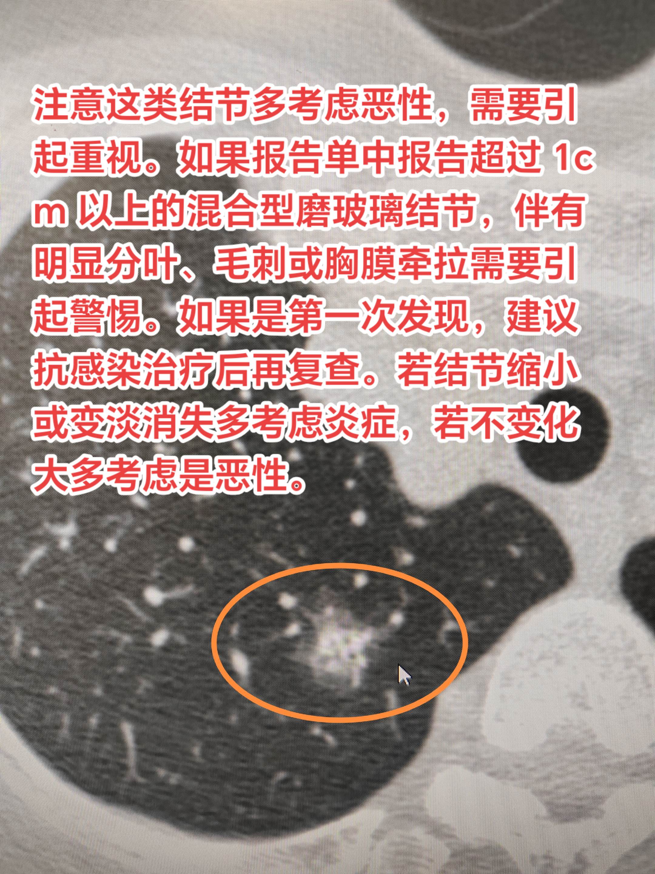 注意这类结节多考虑恶性，需要引起重视。注意这类结节多考虑恶性，需要引起...