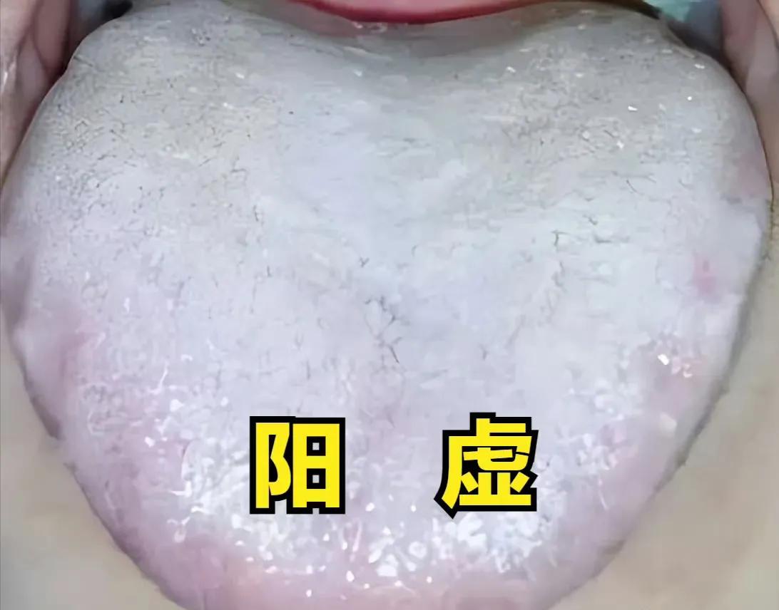 阳虚
即使在温暖的环境中也可能感到寒冷。主要表现畏寒怕冷。
四肢末端尤为明显，对
