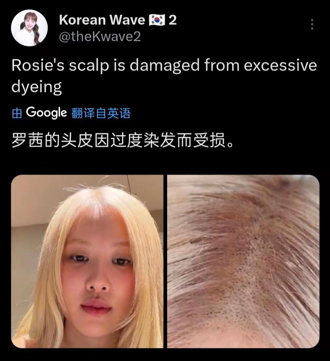 因为想让自己看起来像欧美人

朴彩英长期把自己的头发染成金黄色，现在她的头皮因为