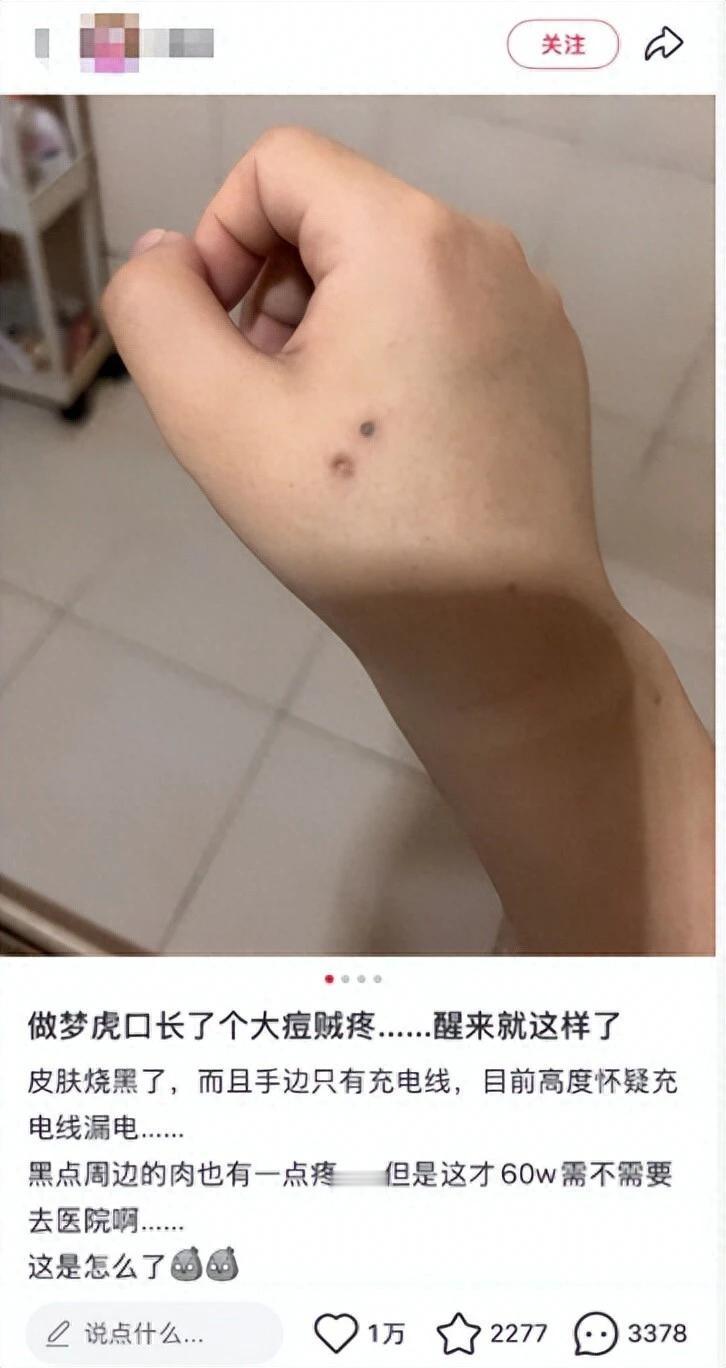 手机充电打游戏，突然“啪”一下，手麻了、起泡了！

别以为皮肉没事就完事，医生紧